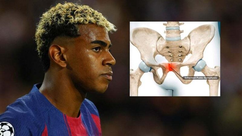 تفاصيل إصابة لامين جمال الثانية ومدة غيابه (صورة)