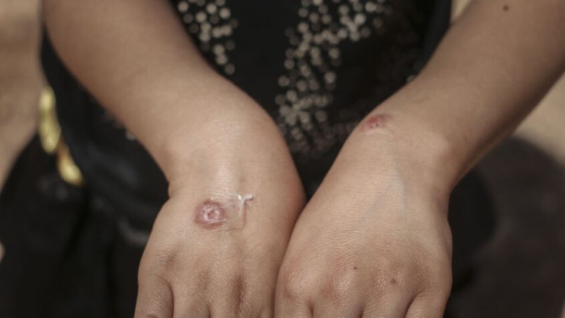 “حبة حلب”  جنوب سوريا تصيب العشرات