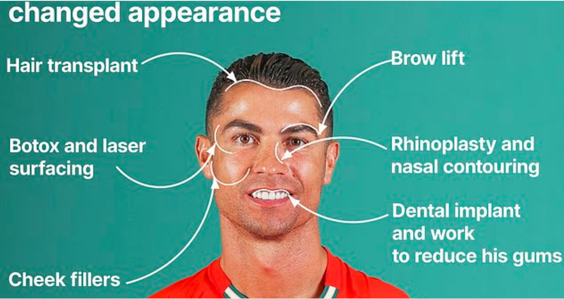 بوتوكس ليزر رفع الحاجبين.. جراح تجميل يكشف أسرار تغير ملامح كريستيانو رونالدو خلال 20 عاما